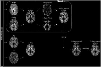 Low myelin-related values in the fornix and thalamus of 7 Tesla MRI of major depressive disorder patients